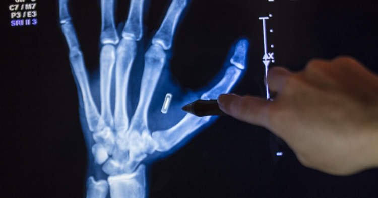 تحديات أمان شريحة RFID المزروعة بعد فقدان كلمة السر رجل يفقد كلمة مرور شريحة RFID المزروعة في راحة يده